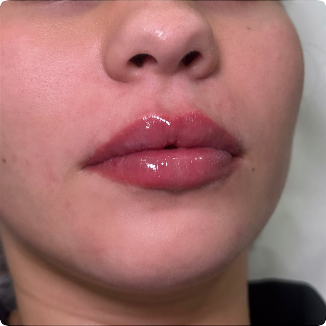 Close view of lips after lip filler with Nadia