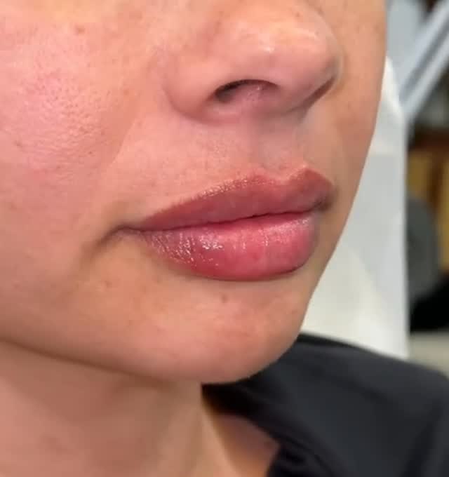 Three-quarter view of lips after lip filler