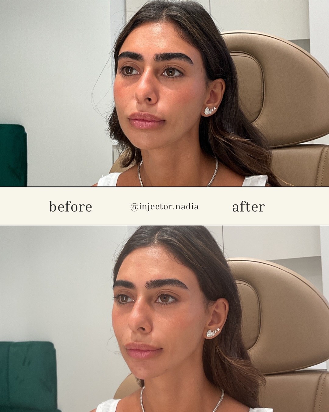 Before and after facial balancing with dermal filler, three-quarter view